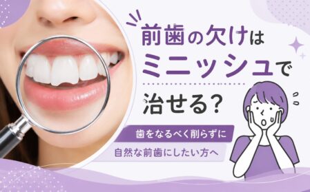 前歯の欠けはミニッシュで治せる？歯をなるべく削らずに自然な前歯にしたい方へ